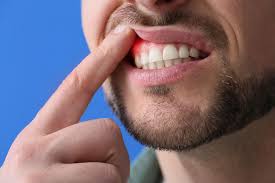 Image result for Gingivitis