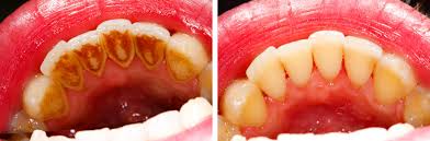 Most people get gingivitis at some point in their lives, and its mild symptoms. Gingivitis Treatment Win The Battle Against Gingivitis Disease