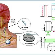 Pdf Vagal Nerve Stimulation For The Treatment Of Depression Stimulation Du Nerf Vague Dans Le Traitement De La Depression