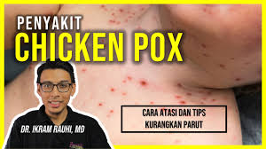 Cara hilangkan parut chicken pox dewasa : Tanda Tanda Chicken Pox Cara Hilangkan Parut Daripada Chicken Pox Atau Cacar Air Beza Dewasa Kanak Youtube