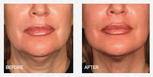 We did not find results for: Hifu Facelifting Skin Tightening Ultherapy Treatment Skin Body Health