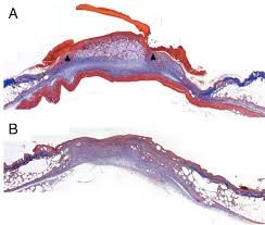How can a diabetic wound heal faster. New Hope For Treating Diabetic Wounds That Just Won T Heal