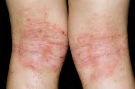 Image result for sweat rash on back baby