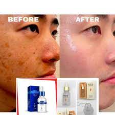Seakan berjuang mengatasi jerawat saja belum cukup berat, luka parut dan eritema pasca inflamasi yang diakibatkannya pun mungkin masih tersisa salah satu produk kecantikan yang patut anda coba adalah bio oil. Hilangkan Parut Teruk Buy 1 Free 1 Hilangkan Parut Jerawat Ubat Jerawat Ubat Jeragat Ubat Putihkan Kulit Viral Shopee Malaysia