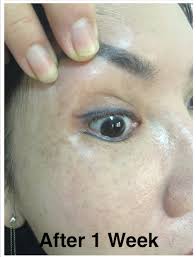 laser eyebrow embroidery tattoo removal