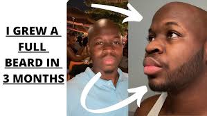 My Minoxidil 1 Year Experience