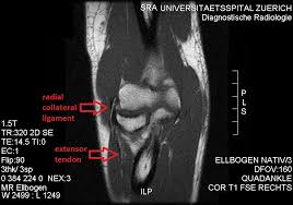 Elbow joint consists of two articulations. Radial Collateral Ligament Of Elbow Joint Wikipedia