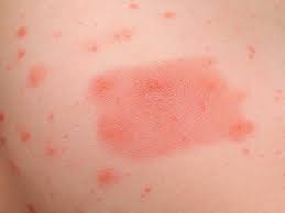 Image result for Papular urticaria