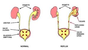 Kids Kidney Disease Urinary Tract Infection Kidney Disease Disease