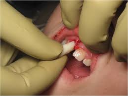 Image result for Tooth Avulsion