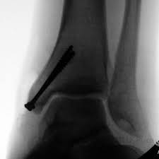 Multiple fractures of lower leg; Medial Malleolus Fracture S82 53xa 824 0 Eorif