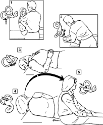 Image result for Canalith Repositioning Procedure