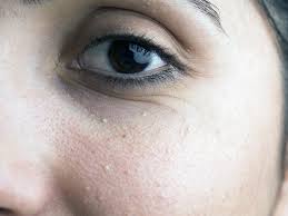 Milia Under Eyes Causes Diagnosis And Treatment milia under eyes causes diagnosis