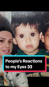 Yepp, They're real. 🙈 #fyp #megalocornea #BritneySpears #FaceMask #BigEyes