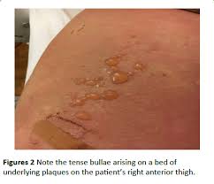Image result for pruritic urticarial papules and plaques of pregnancy