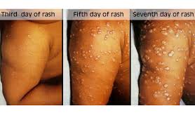 Get the facts on treatment, prevention, prognosis, and diagnosis. Smallpox Variola Variola Major Variola Minor Variola Vera Alastrim The Pox Variole Viruela Pocken Blattern Dermatology Advisor