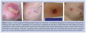 Image result for Pyoderma Gangrenosum