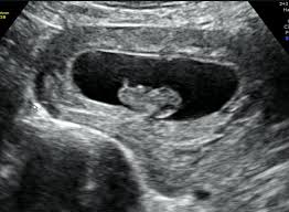 Image result for Ultrasound