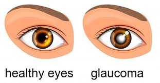 Coastal eye institute is an ophthalmology practice with eye doctors specializing in the areas of cataract, lasik, retina, glaucoma and pediatrics. Glaucoma Symptoms Treatment And Prevention Royal Spanish Center