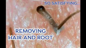 Check spelling or type a new query. Squishy S 2 Ingrown Hair Root Removal Microscopic Youtube
