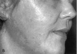 LASER RESURFACING OF ATROPHIC SCARS