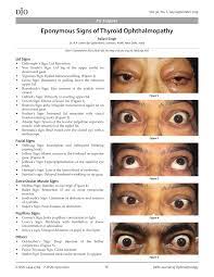 It is found in patients with graves' disease. Pdf Eponymous Signs Of Thyroid Ophthalmopathy