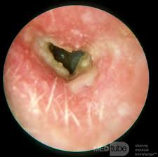 Image result for Acute Otitis Externa