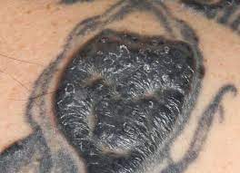 Ideas + reccomendations on steve. Inflammatory Tattoo Reaction Dermatology Advisor