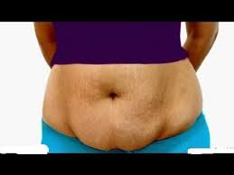 How To Get Rid Of Hanging Belly After C-Section And Get Back To Shape Fast:  7 Proven Methods| Kiddiesquare