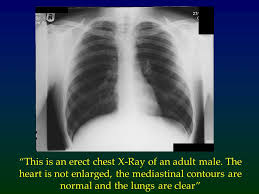 Anatomy of chest x ray. The Normal Chest X Ray Ppt Video Online Download