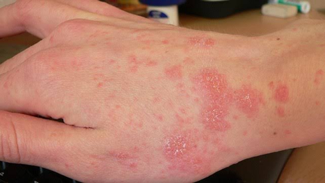 Image result for Which Are Scabies Symptoms Cures"