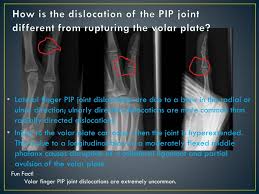 Image result for Lateral PIP Dislocation
