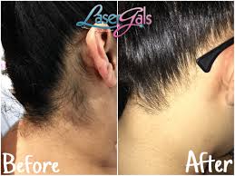 We have all the information you need about public and private beauty salons that provide laser hair removal in switzerland. Laser Hair Removal Microneedling Skin Care Treatment Laser Gals Skin Studio Yuma Az 85365