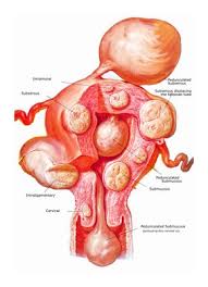 Maybe you would like to learn more about one of these? Myomectomie