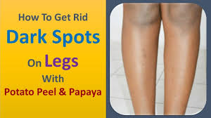 See full list on effectiveremedies.com How To Get Rid Dark Spots On Legs With Potato Peel Papaya Youtube