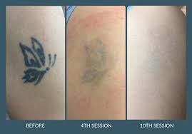 7 cresset centre, peterborough pe3 8dx, uk peterborough, england pe3 8dx. Laser Tattoo Removal In Leicester G Lasers