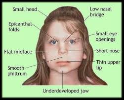 The main facial feature associated with epicanthal folds include flat nasal bridge due to. Pin By Jaime Anderson On Foetal Alcohol Syndrome Fetal Alcohol Syndrome Fetal Alcohol Foetal Alcohol Syndrome