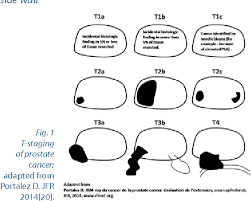 It may grow slowly and it's typically treatable. Pdf Ed It Or Ia L Use Of Multiparametric Mri In T Staging Of Prostate Cancer Semantic Scholar
