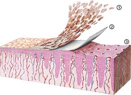 Image result for Auspitz Sign