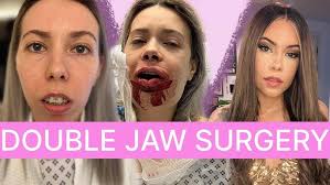 Story time: Upper Jaw Surgery Experience