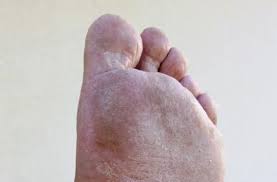 Athlete S Foot Symptoms Causes And Treatments