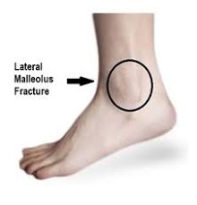 Kingbrand.com has been visited by 10k+ users in the past month Weber B Fracture V1 Virtual Fracture Clinic