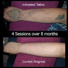 See reviews, photos, directions, phone numbers and more for the best tattoo removal in atlantic city, nj. Ctrl Alt Del Tattoo Removal Lightening Tattoo Removal Beauty4me