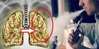 Interesting E Cigarettes Cause A Horrible Incurable Disease Called Popcorn Lung Worse Than Lung Cancer Jerminix
