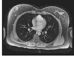 Normal Magnetic Resonance Imaging Of The Thorax Semantic Scholar
