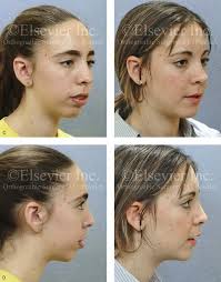 Malocclusion after Orthodontics and Orthognathic Surgery: Prevention and  Treatment Pitfalls