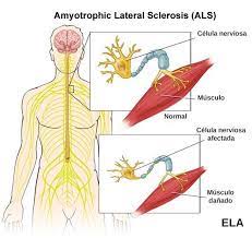 La esclerosis lateral amiotrófica y. Esclerosis Lateral Amiotrofica Ela Cuando Nuestro Cuerpo Deja De Obedecernos