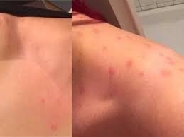 Ich mag radfahren, denn es hilft mir gesund zu bleiben. Rote Vogelmilbe Bei Mausen Symptome Behandlung Quarantane