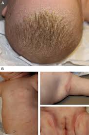 Check spelling or type a new query. Differential Diagnosis Of Atopic Dermatitis Immunology And Allergy Clinics