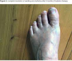 One large cyst or many smaller cysts can appear that look like one large lump. Injury To The Big Toe Leads To An Unexpected Lymphoma Oncology Nurse Advisor